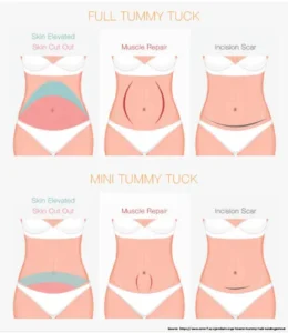 Benefits of Undergoing Tummy Tuck Surgery