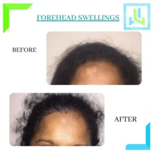 forehead-swellings