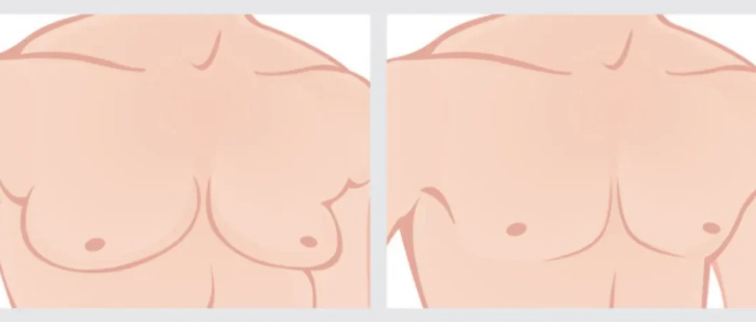 Gynecomastia – All you need to know