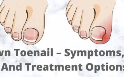 Ingrown Toenail – Symptoms, Causes, And Treatment Options