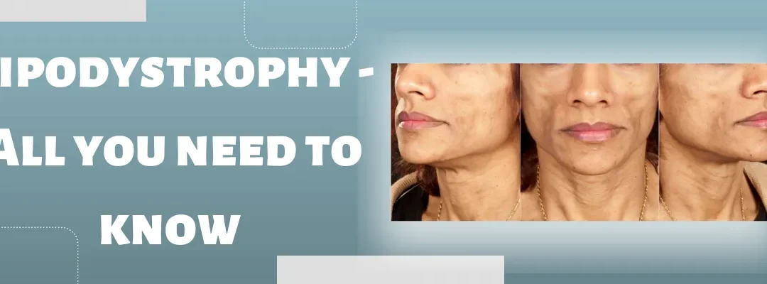 Lipodystrophy - All you need to know