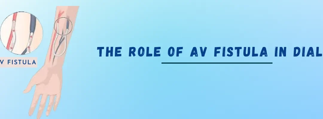 The Role Of AV fistula In Dialysis
