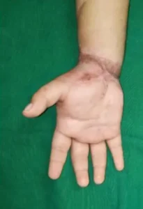 wrist-amputation