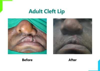 Adult Cleft Lip