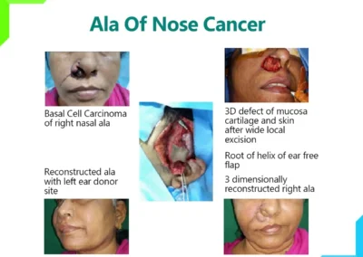 Ala Of Nose Cancer