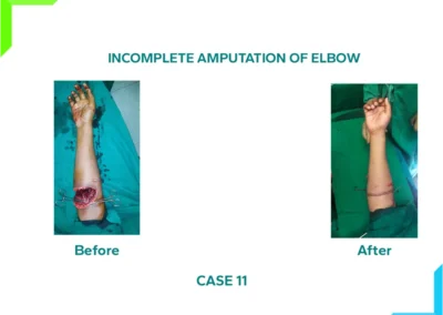 Incomplete Amputation of Elbow - Vascular repair