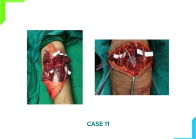 Incomplete Amputation of Elbow - Nerve repair