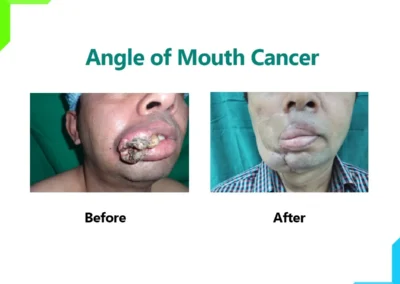 Angle of Mouth Cancer