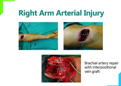 Arm Arterial Injury