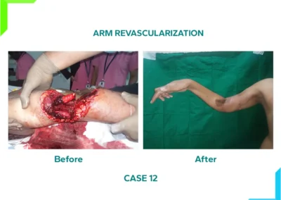 Arm revascularization