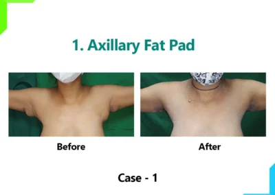 Axillary Fat Pad Case-1