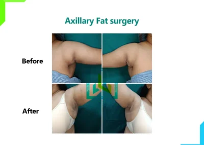 Axillary Fat surgery