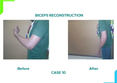 Elbow crush injury with biceps loss - Biceps Construction