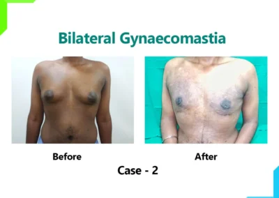 Bilateral Gynaecomastia Case-2
