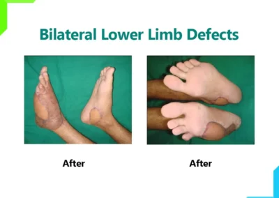 Bilateral Lower Limb