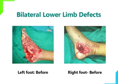 Bilateral Lower Limb Defects