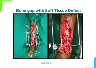 Bone gap with Soft Tissue Defect