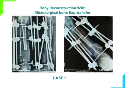 Bony Reconstruction with Microsurgical bone flap transfer