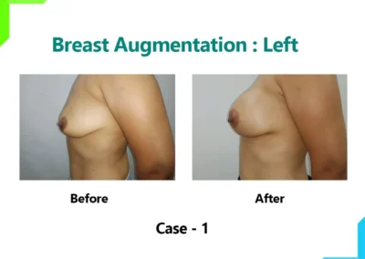 Breast Augmentation Case-1