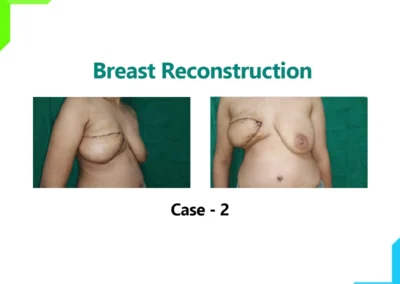 Breast Reconstruction Case-2