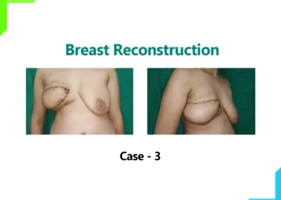 Breast Reconstruction Case-3