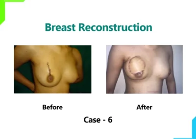 Breast Reconstruction Case-6