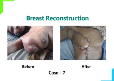Breast Reconstruction Case-7