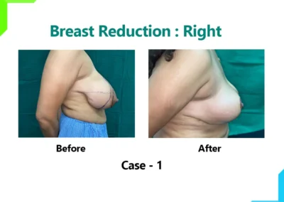 Breast Reduction Case-1