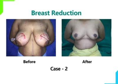 Breast reduction Case-2