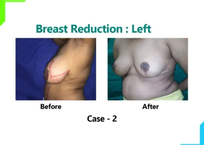Breast reduction Case-2
