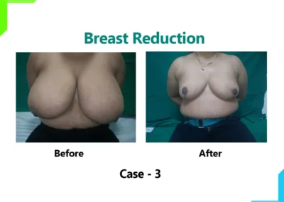Breast reduction Case-3