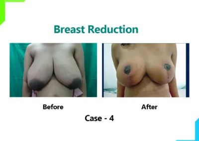 Breast reduction Case-4