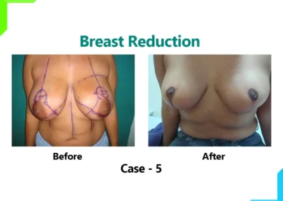 Breast reduction Case-5