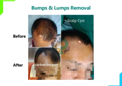 Bumps and Lumps removal