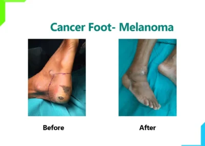 Cancer Foot - Melanoma