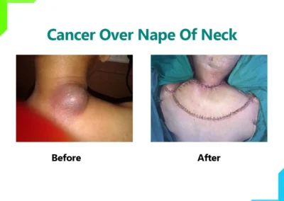 Cancer Over Nape of Neck