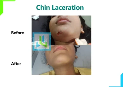 Chin Laceration