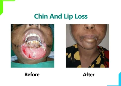 Chin and Lip Loss