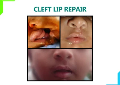 Cleft Lip Repair