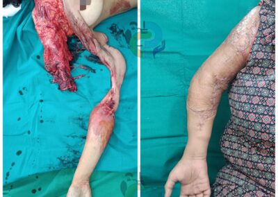 Complex Right elbow amputation with degloving - Replantation