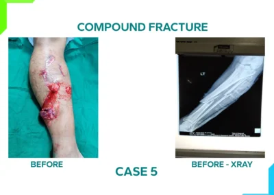 Compound Fracture Case 5