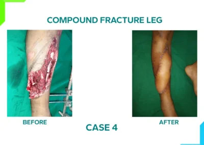 Compound Fracture leg Case 4