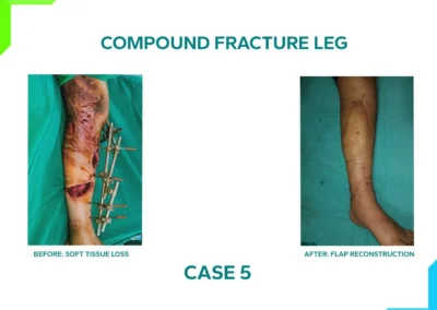 Compound Fracture leg Case 5