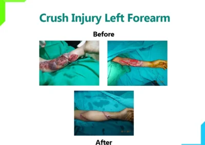 Crush Injury left forearm