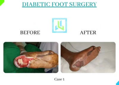 Diabetic Foot Surgery Case 1
