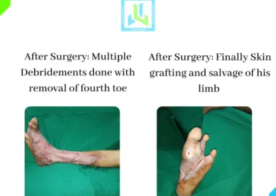 Diabetic Foot Surgery Case 2