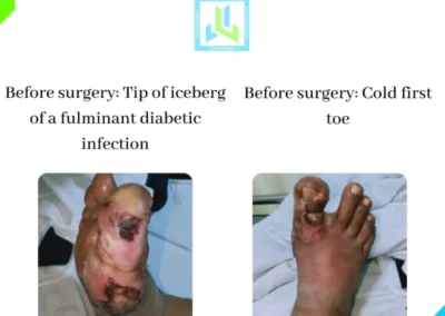 Diabetic Foot Surgery Case 3