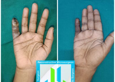 Diabetic Hand Infection