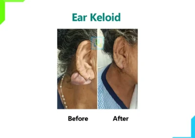 Ear Keloid