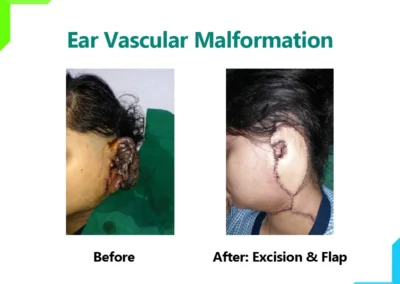 Ear Vascular Malformation